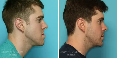 Underbite Jaw Surgery Before and After