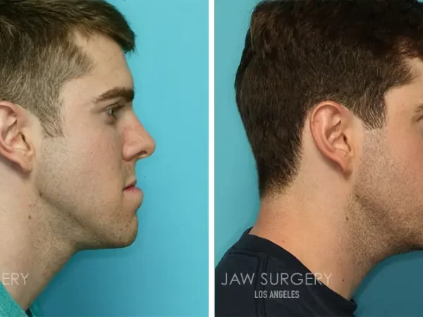 Underbite Jaw Surgery Before and After